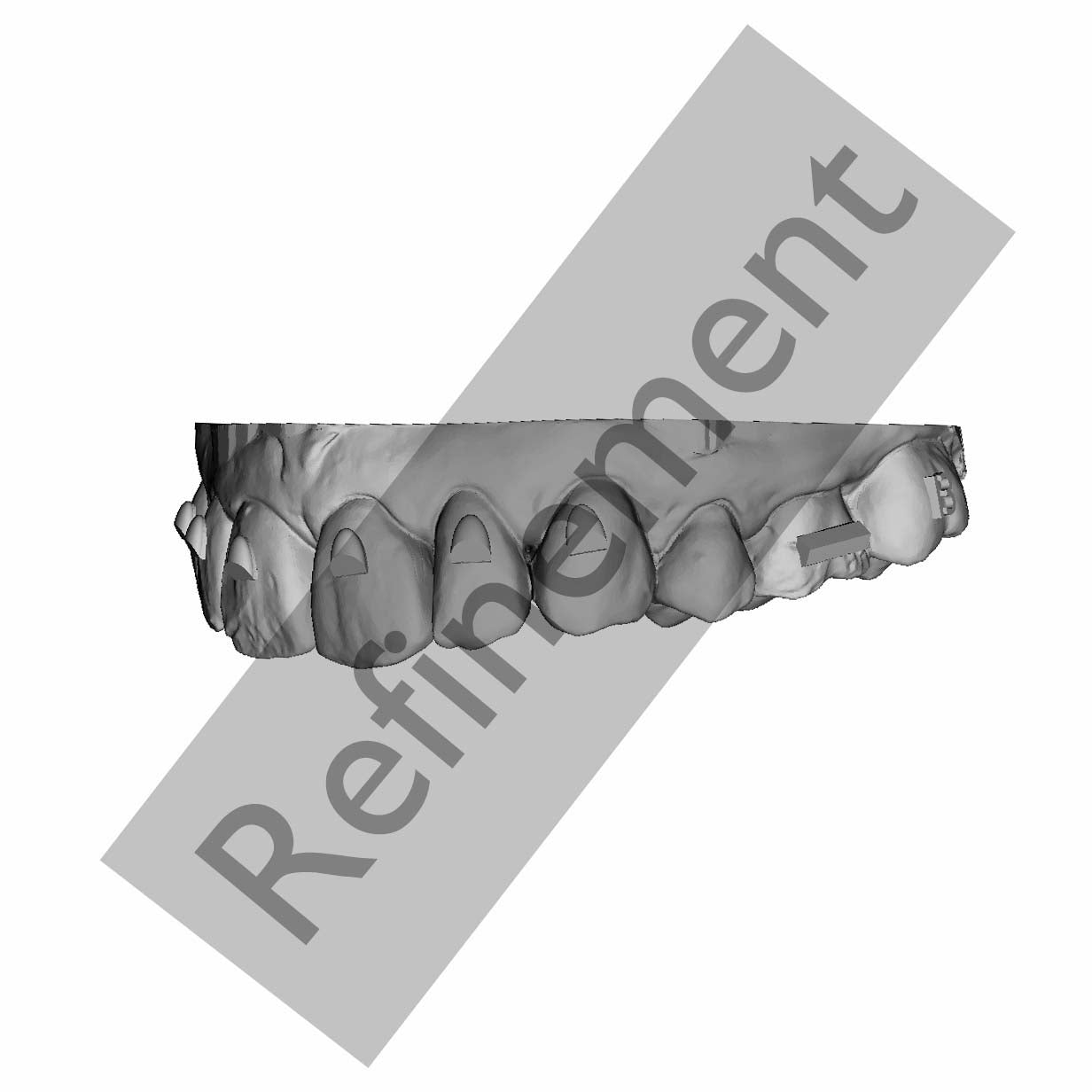 Aligner refinement